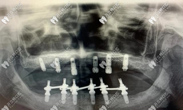 全慶波醫(yī)生分析即刻負重的種植牙靠譜