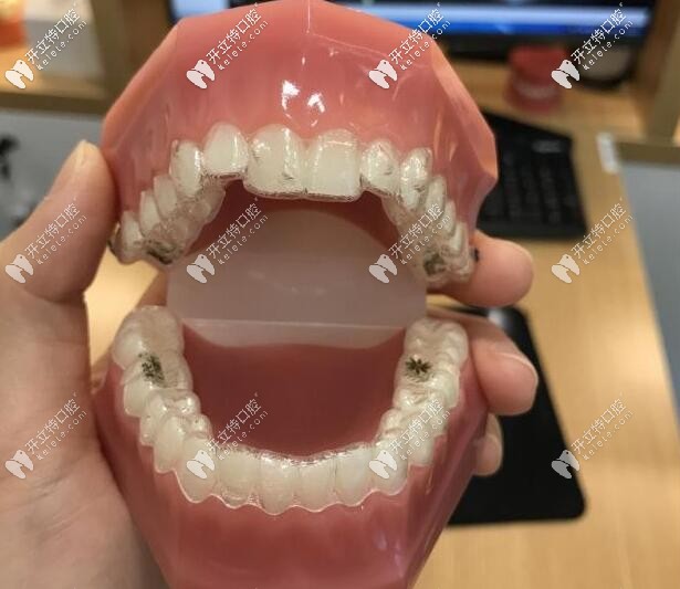 隱適美矯正牙套 