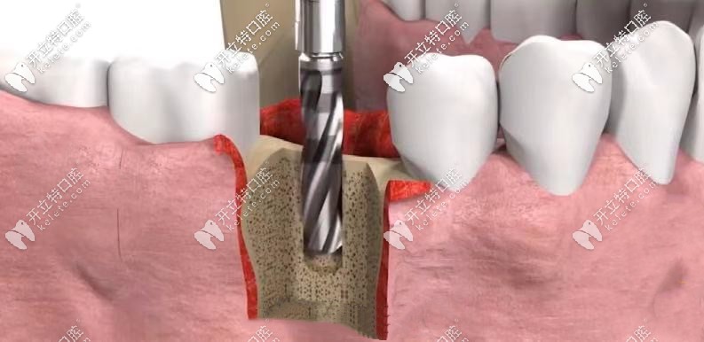 3D動畫演示種植牙的全過程步驟視頻|3d數(shù)字化種植牙費用不貴