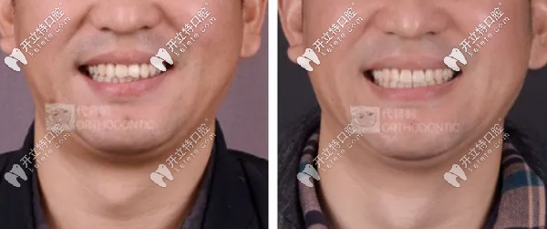 代育桐醫(yī)生矯正案例二