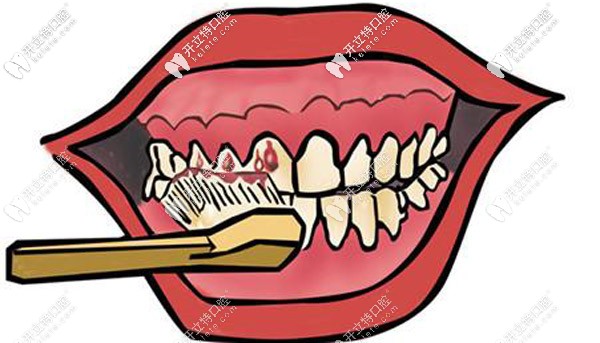 6D納米浮雕牙好卸嗎，可參考6d納米浮雕牙卸掉視頻