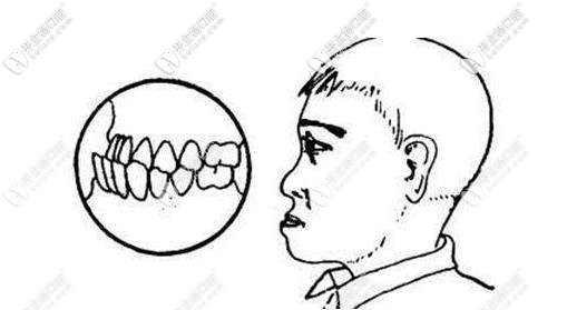 地包天側(cè)面樣子