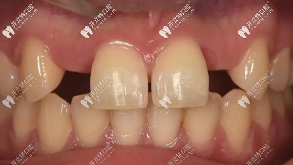前牙區(qū)用瑞士士卓曼Variobase AS基臺做即刻種植牙修復(fù)的案例