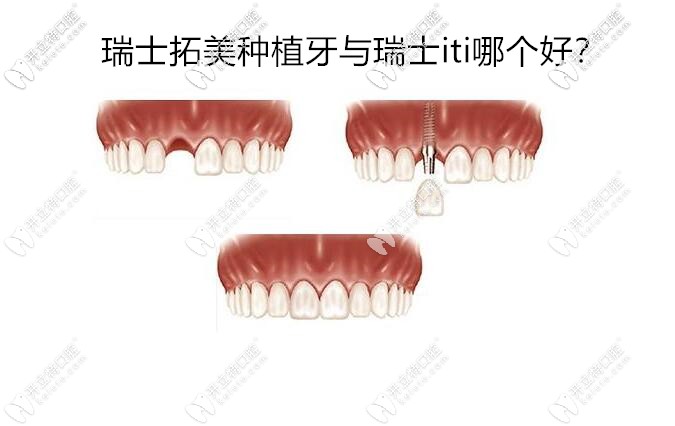 瑞士拓美種植牙15000的價(jià)格貴不貴,thommen與瑞士ITI哪個(gè)好