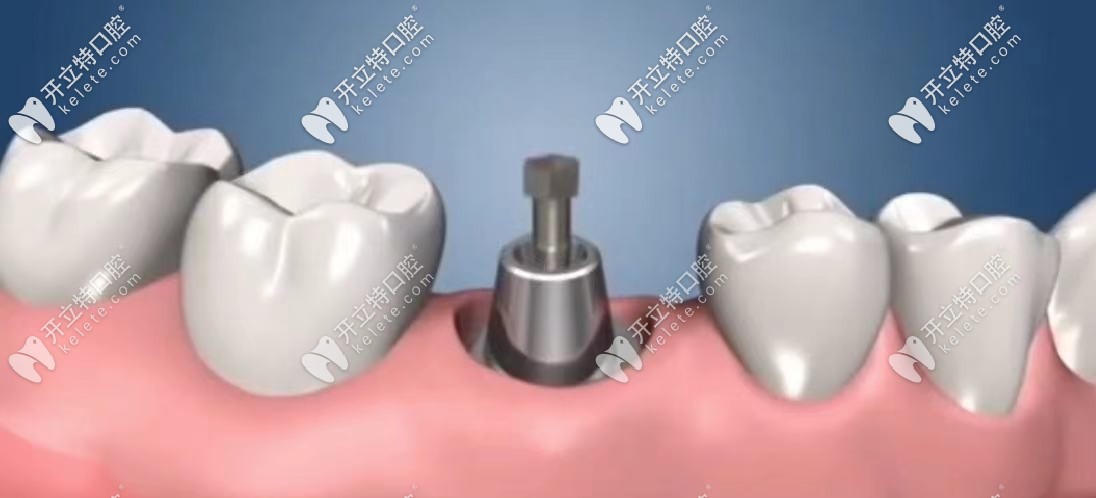 卸掉螺釘，換上鈦金屬的連接基臺(tái)