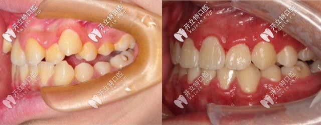 矯正前后對(duì)比