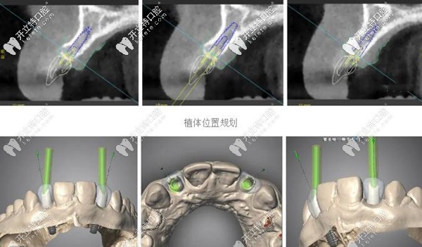 前牙做即刻種植術(shù)前檢查
