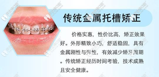 國產(chǎn)傳統(tǒng)金屬鋼牙套優(yōu)勢