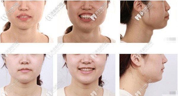 樂樂欣口腔段斌醫(yī)生分享隱適美解決笑露牙齦矯正手術