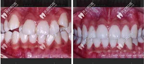 福州維樂牙列畸形矯正<span style=