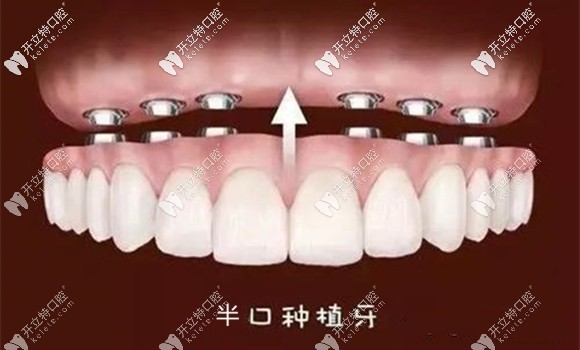 allon6半口種植牙示意圖