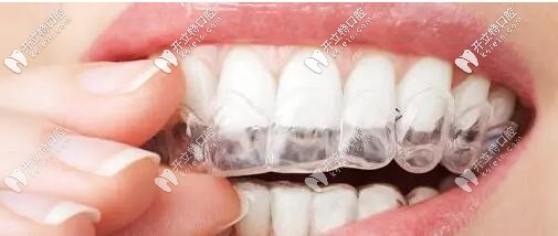 牙齒保持器哪種成效好?對(duì)比哈雷/透明/舌側(cè)保持器優(yōu)缺點(diǎn)