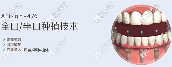 半口牙種植幾顆植體合適,是4顆好還是6顆好呢?價(jià)錢一樣不