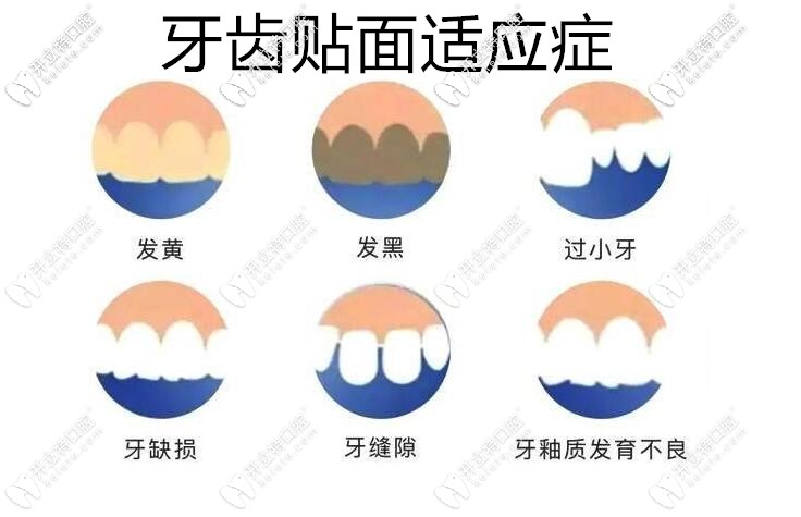 牙齒貼面一顆4000貴嗎?我門(mén)牙牙縫大2mm做牙齒貼牙片多少錢(qián)