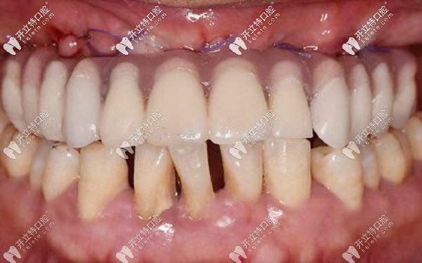 做的義齒帶上去也很合適