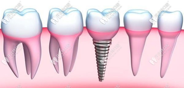 拔完牙后多久可以種植牙?其實拔牙后做種植的時間因人而異