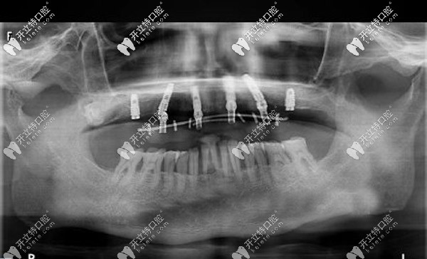 通過(guò)數(shù)字化動(dòng)態(tài)導(dǎo)航種植恢復(fù)半口牙