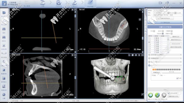 數(shù)字化動態(tài)導(dǎo)航種植技術(shù)