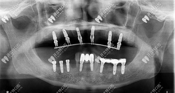 半口牙種植6或8顆植體全景圖