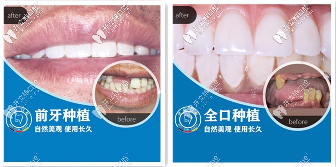 德益口腔-單顆種植和全口種植牙案例展示