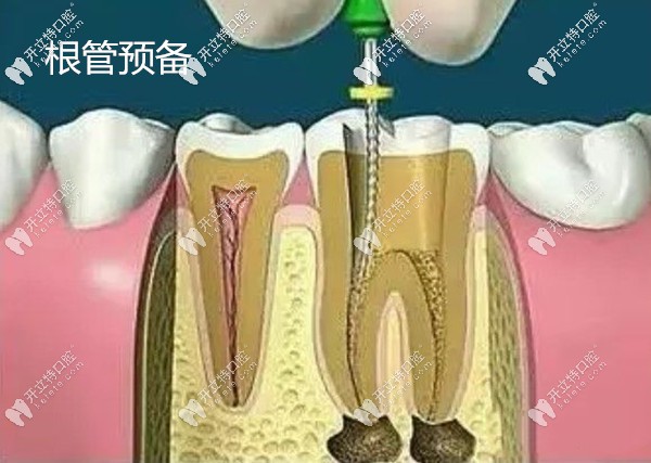 高清版牙齒根管治療過程的視頻,告訴你多久能完成治療