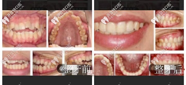 福州維樂牙齒擁擠排列不齊矯正