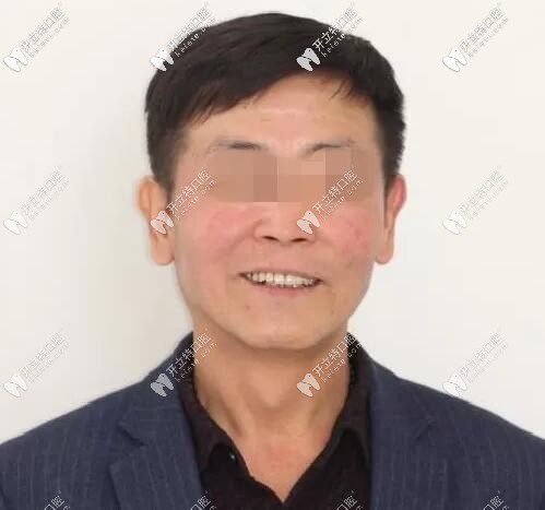 上頜竇外提升喜提ALL-ON-6半口馬龍橋種植牙,10年活動(dòng)義齒拜拜