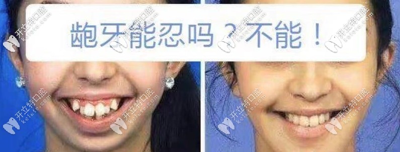 齙牙凸嘴矯正前后對比圖