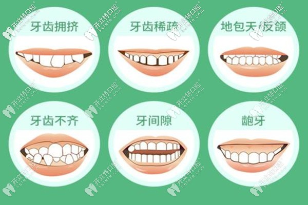 蘭州牙王國口腔金屬矯正，舌側(cè)矯正多少錢