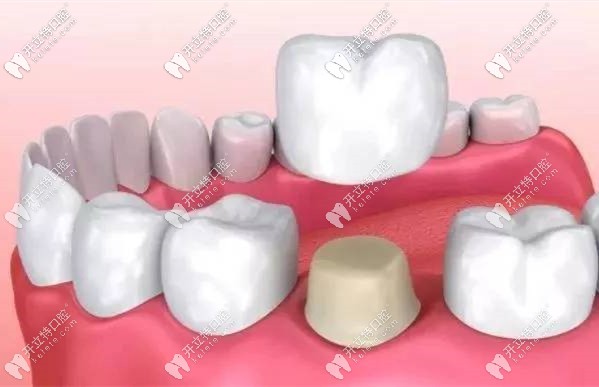 全瓷牙國產(chǎn)和進口的區(qū)別