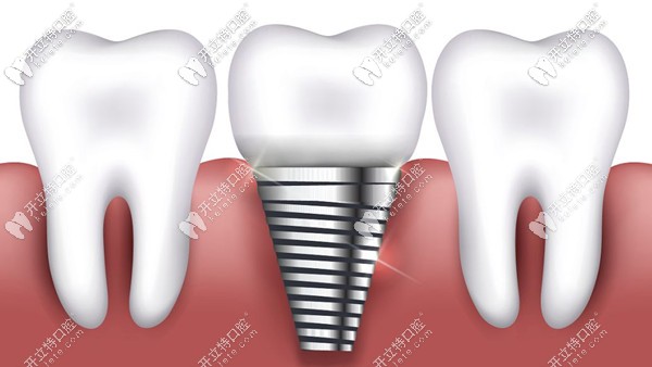 深圳正夫口腔進(jìn)口種植牙的收費(fèi)