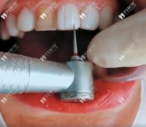 卸除樹(shù)脂牙貼面價(jià)位大概多少錢(qián)一個(gè)?水激光卸除價(jià)格了解下