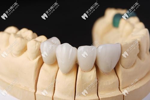 回復(fù)我：美國3m全瓷牙和澤康的區(qū)別？lava全瓷牙多少錢一顆