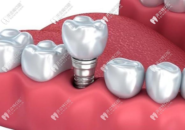 諾貝爾PMC種植體價(jià)格親民