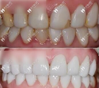 氧化鋁全瓷貼面