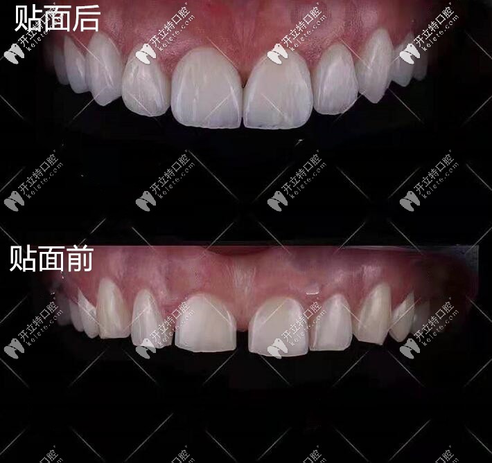 朋友剛做的超薄瓷貼面效果對比