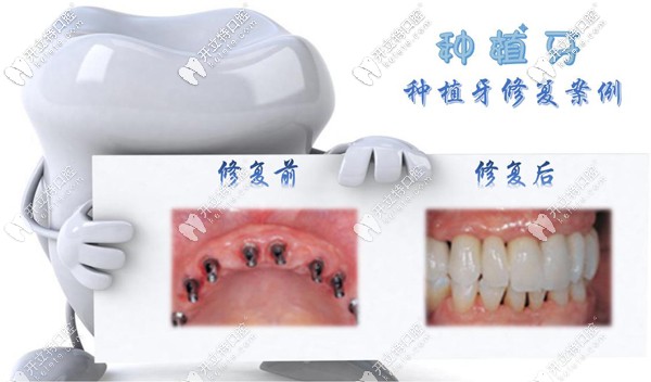 諾貝爾PMC可做前牙種植