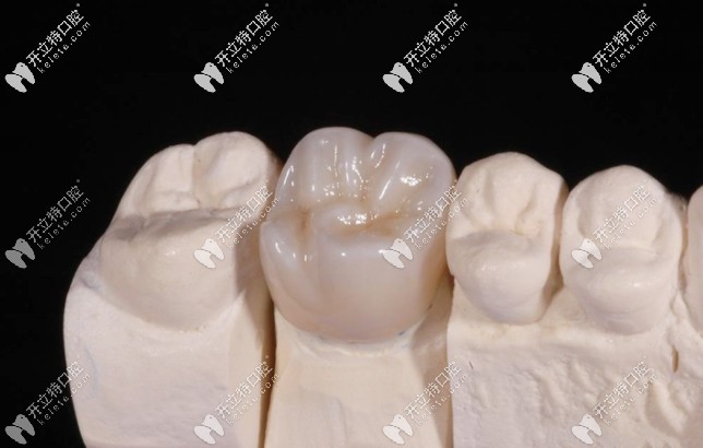 全瓷牙圖片