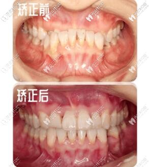 骨性反頜戴牙套效果