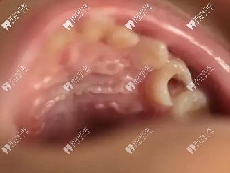 重度牙齒齲壞會導(dǎo)致補(bǔ)牙材料脫落