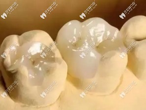 補(bǔ)牙材料脫落的常見因素有哪些