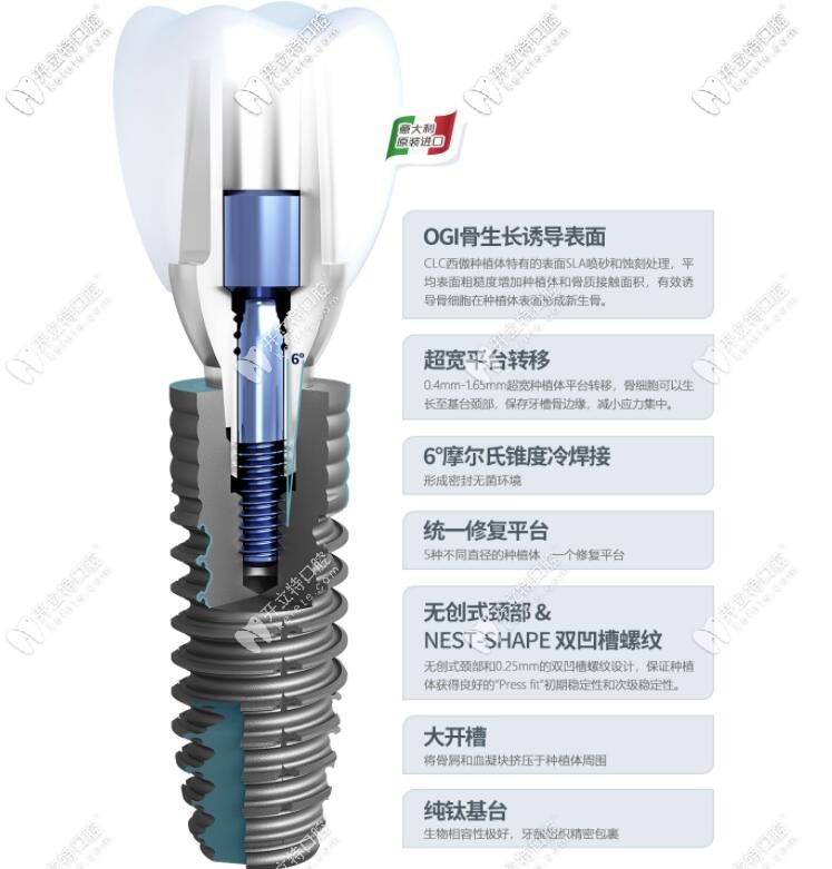 西傲（clc）種植牙優(yōu)勢(shì)介紹