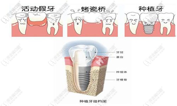 種植牙與活動假牙、烤瓷牙對比圖