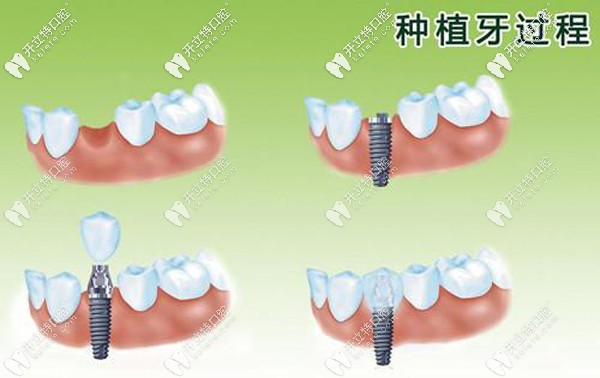 種植牙過程圖