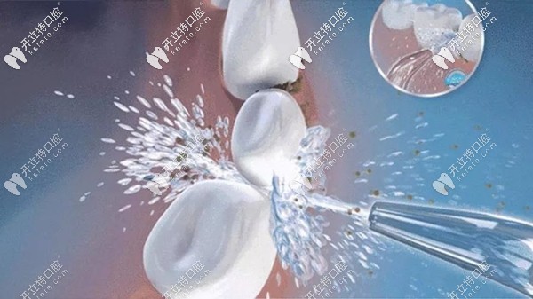 參照洗牙的分類等級表來自測你的牙齒需要做幾級洗護(hù)