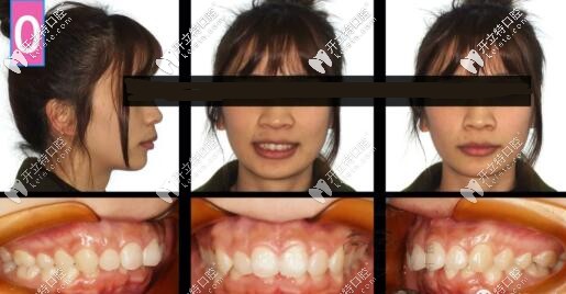 骨性二類(lèi)凸嘴正畸內(nèi)收3-4mm側(cè)貌效果,金屬自鎖(拔牙+骨釘)