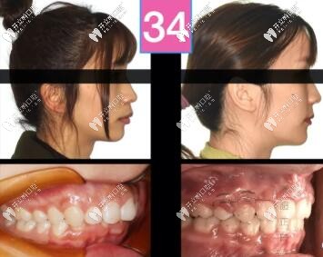 骨性二類(lèi)凸嘴單純正畸牙齒內(nèi)收3-4mm側(cè)貌效果圖