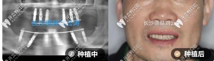 劉云濤：上半口all-on-6種植、下半口all-on-4種植