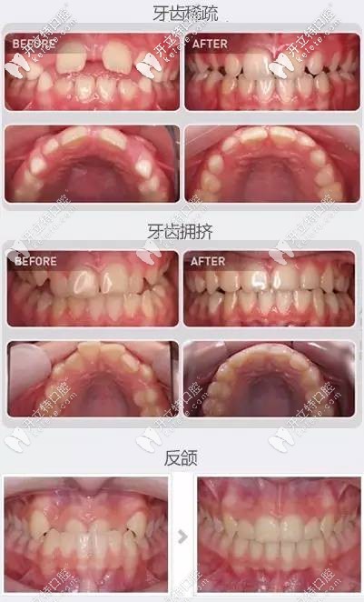 熊醫(yī)生-兒童早期牙齒矯正案例（牙齒不齊、反頜等癥狀）
