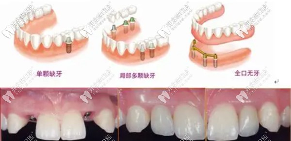 重慶牙博士當(dāng)天種牙、當(dāng)天戴牙當(dāng)天用